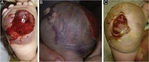(A) Ulcerated and bleeding tumor mass. (B) After 13 weeks, significant increase in size (before the chemotherapy). (C) Tumor and ulcer reduction after adjuvant chemotherapy and before amputation.
