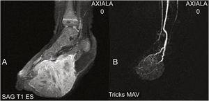 (A) MRI identifying an expansive mass with diffuse contrast enhancement. (B) MRA showing an expansive lesion supported by vascular structures. There is no evidence of arteriovenous fistulas or nidus.