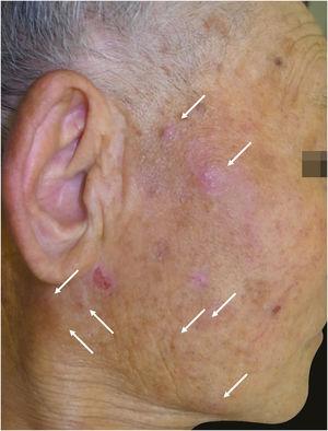 Red or skin color nodules with mild pruritus on the right cheek (arrow).