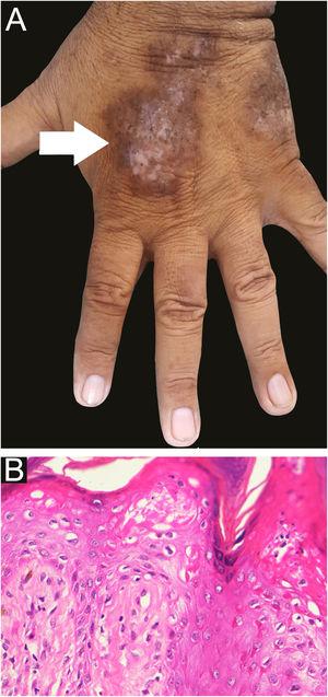 A - clinical image of hypertrophic lichen planus (arrow) B - histopathological examination shows hyperkeratosis, parakeratosis, acanthosis, basal cell vacuolation and lymphocytic infiltrate (Hematoxylin & eosin ×400).