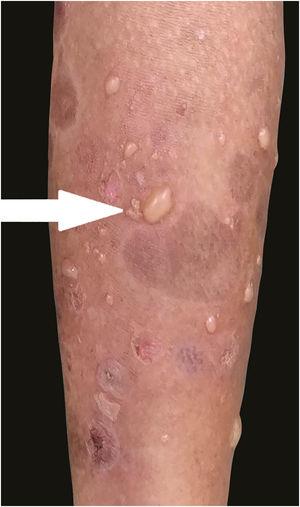 Clinical image of bullous pemphigoid like lesions over normal and inflamed skin (arrow).