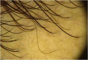 Dermoscopy of the unaffected skin of the scalp, at the frontotemporal hair line. There is no evidence of yellow dots.