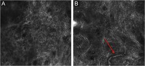 RCM of the papillary dermis. (A) Diffuse dark areas, with hyper reflective coils and parallel structures corresponding to the fibrillar collagen bundles. (B) The vessels appear as tubular dark structures with small shiny white structures corresponding to the blood cells (red arrow).
