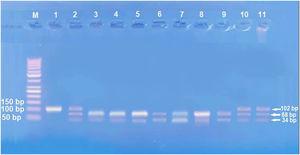 Agarose gel electrophoresis images for IL-17A genotypes, GG genotype 3, 4, 5, 6, 7 and 9 lanes, AG genotype 2, 10 and 11 lanes, AA genotype 1 and 8 lanes.