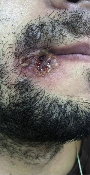 Monkeypox. Confluent pustules outlining central umbilication, and central ulcero-necrotic area, located in the right labial angle.