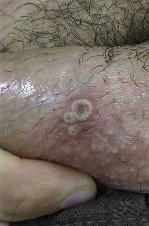 Monkeypox. Three pustules with central umbilication on the shaft of the penis.