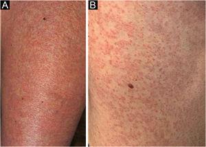 (a) Diffuse erythema and papules on the left thigh; (b) In detail, erythematous-brown follicular papules over erythema on the lateral-posterior aspect of the left trunk.