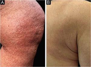 (a) Finely desquamative, parchment-like erythematous-brown plaques on the distal third of the left thigh and knee; (b) and on the right scapular region, after 2 months.