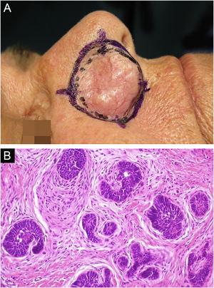 Recurrent trichoblastoma. (A) (top image: clinical delimitation during MMS. (B) (lower image (paraffin-embedded section, Hematoxylin & eosin): proliferation of follicular germ cells forming, islets of basaloid cells inside a fibrocellular stroma. Source: Archives of Dermatology HC-Unicamp.