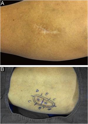 (A) Scar on the right leg secondary to previous conventional surgery. (B) Clinical delimitation of recurrent spiradenoma during MMS. Source: Archives of Dermatology HC-Unicamp.