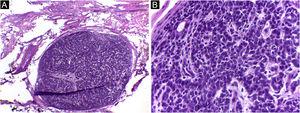 Spiradenoma (5-micron thick frozen sections stained with Hematoxylin & eosin). (A) (image on the left): multinodular pattern, with relatively large and circumscribed nodules within the dermis and subcutaneous tissue. (B) (image on the right): Basaloid cells of two types. In the periphery they are small with hyperchromic nuclei and in the center or around small lumens they are larger with pale nuclei. Source: Archives of Dermatology/Pathological Anatomy HC-Unicamp.