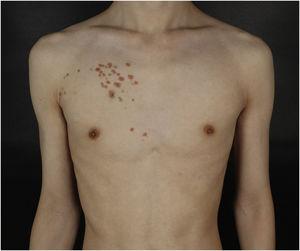 Physical examination revealed yellowish-brown firm, smooth papules, and plaques on his right chest. Distribution of the lesions followed Blaschko's lines.