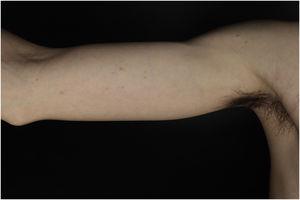 Lesions on the right upper limb.