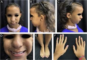 Patient’s (B and C) phenotypic characteristics (A). Pear-shaped nose, diffuse hair rarefaction, more intense in the frontotemporal regions. Close up view of the pear-shaped nose (D). Joint deformities in the feet and hands (E and F).