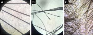 Trichogram. (A) Trichoscopic analysis under optical microscopy showing normal hair shafts. (B) At the highest magnification, normal telogen hairs are observed. (C) Trichoscopy was normal, although it showed fine hairs corresponding to hypotrichosis.