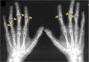 Hand x-ray showing coned epiphyses in the middle phalanges (yellow arrows).