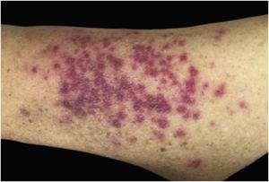 Leukemia cutis in a patient with AML ‒ confluent purpuric papules and some isolated ones with a rough surface on the lateral aspect of the left arm.