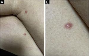 Leukemia cutis in a patient with AML. (A) Post-allogeneic BMT recurrence – two isolated erythematous, smooth, hardened papules on both thighs. (B), Detail of the lesion at higher magnification.