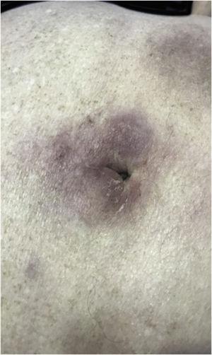 Cutaneous plasmacytoma. Erythematous-violaceous nodules, poorly defined and infiltrated in the periumbilical region.
