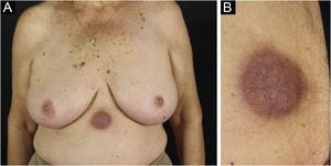 Secondary cutaneous follicular lymphoma. (A) Brownish-erythematous, infiltrated subcutaneous tumor, with telangiectasias in the epigastric region. (B) Lesion at higher magnification.