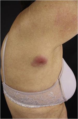 Secondary cutaneous CD30+ anaplastic lymphoma – erythematous, infiltrated, raised, reddish plaque in the central portion on the posterior right axillary line.