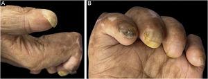 Images of the 1st patient. (A) First fingernail of the left hand showing PBN deformity. (B) All the fingernails were involved, with associated contracture of all the fingers and atrophy of hand muscles. Second fingernail shows focal plate thickening and brown chromonychia, third fingernail shows onycholysis and yellow chromonychia, and longitudinal melanonychia of third and fourth fingernails is noticed.