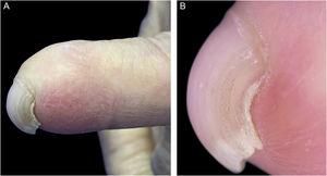 Images of the 2nd patient. (A) PBN deformity of the fifth left fingernail. (B) Dermoscopy enhances the visualization of the characteristic nail plate over curvature.