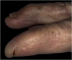 Image of the 3rd patient. PBN deformity secondary to trauma of the second fingernail, with associated pulp atrophy.
