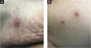 Vesiculopustular lesions with central ulceration at the plantar surface (A), and thigh (B).