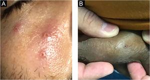 Typical MPX vesiculopustular lesions with central ulceration at face (A) and penis (B).