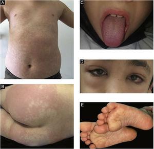 (a) Maculopapular rash on the trunk. (b) Erythematous urticarial plaque on the gluteal skin. (c) Strawberry tongue. (d) Periorbital edema and conjunctival injection. (e) Bilateral plantar erythematous macules.