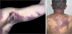 Non-painful purpuric lesions, violaceous papules, nodules and tumors of varying sizes on the armpit, upper limb, cervical region and trunk.
