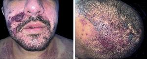 Non-painful papules, nodules and violaceous tumors on the face and scalp, of varying sizes.