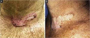 (A) Unaesthetic cicatricial plaque with hyperkeratotic edges after treatment for sporotrichosis. (B) Residual lesion after four cryotherapy sessions.