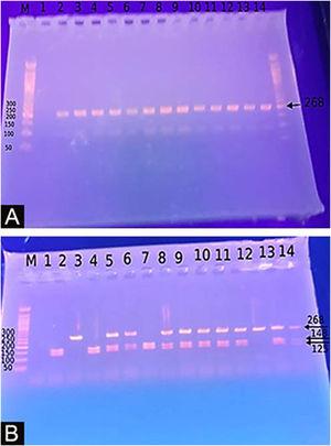 (A) Agarose gel electrophoresis images PCR product: 268-bp. (B) Agarose gel electrophoresis images for DEFB1 SNPs G20A, AA genotype: 268-bp, GG genotype: 143-bp, 125-bp, AG genotype.