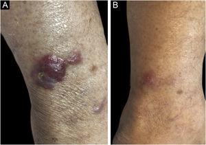 Tumor lesion on the left leg, before and after the shave biopsy. (A) A red, firm, 4-cm nodule on the left leg, with adjacent similar papules, before the shave biopsy. (B) Clinical aspect of tumor regression three weeks after the shave biopsy.