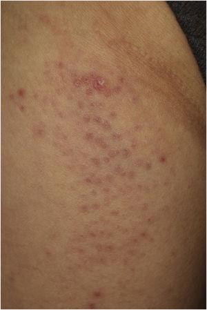 Clinical features of follicular papules on the thigh.