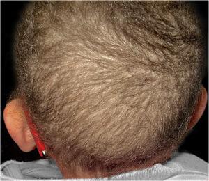 Short brittle hair easily broken at different lengths.