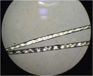 Examination of the hair under a polarized microscope: trichoscisis with typical “tiger-tail pattern”. Note the alternating dark and light transverse banding.