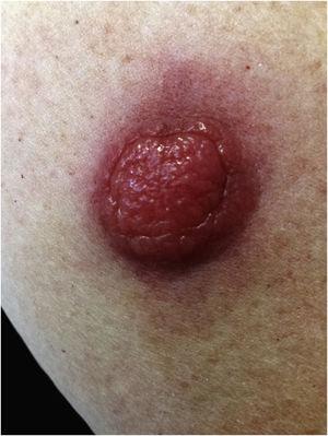 A large pink, erythematous nodule on the skin of the right arm.