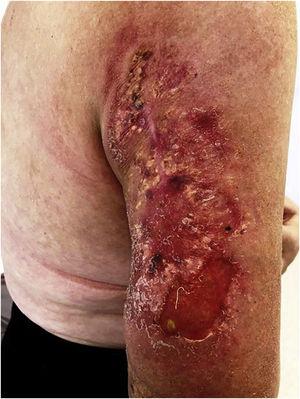 Condition after radiotherapy (first cycle) and surgical debridement.