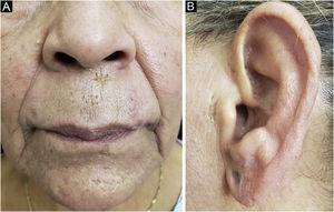 Open comedones and acneiform scars on the supralabial, mentum and preauricular regions after treatment.