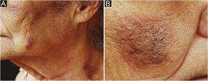(A–B) Infiltrated erythematous plaques, containing open comedones, on the malar, mandibular and cervical regions.