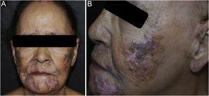 Open and closed comedones over active discoid lupus erythematosus plaques; (A) Distribution of plaques on the face; (B) Detail of the lesion.