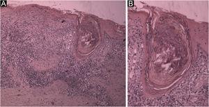 (A) Histological section showing hyperkeratosis, epidermal thinning, liquefaction degeneration of the basal layer and large follicular plug; in the dermis, superficial and deep periadnexal and perivascular mononuclear infiltrate (Hematoxylin & eosin, ×40). (B) Detail of the follicular plug obstructing a dilated hair follicle. Note the liquefaction degeneration of the follicular wall and adjacent epidermis (Hematoxylin & eosin, ×100).