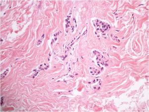 Histopathology of the incisional biopsy showing epithelial aggregates of atypical cells (Hematoxylin & eosin, ×400).