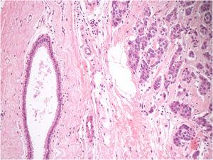 Histopathology of the excisional biopsy showing ectopic mammary glandular tissue and dermal infiltration by carcinomatous cells (Hematoxylin & eosin, ×400).