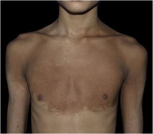 Multiple brown macules with hypertrichosis on the chest, shoulders, upper arms and axillae.