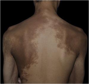 The pigmentation on the neck and scapular regions.