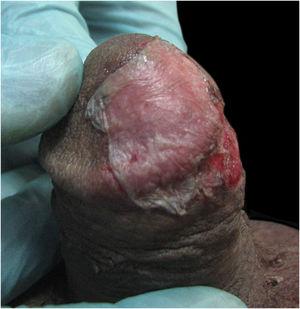 Harvested epidermal graft located over the recipient abraded site.